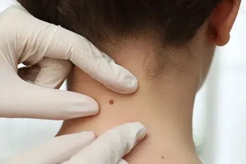 Mole Biopsy