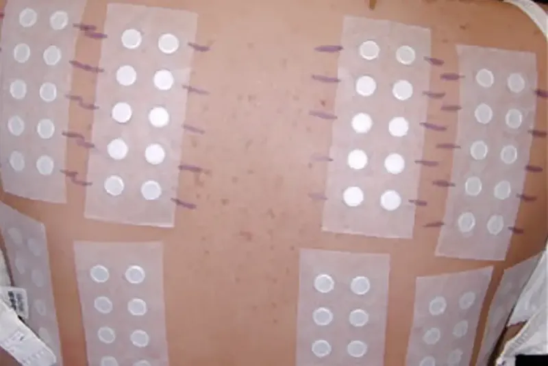 Patch Testing