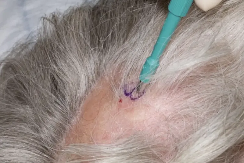 Scalp Biopsy