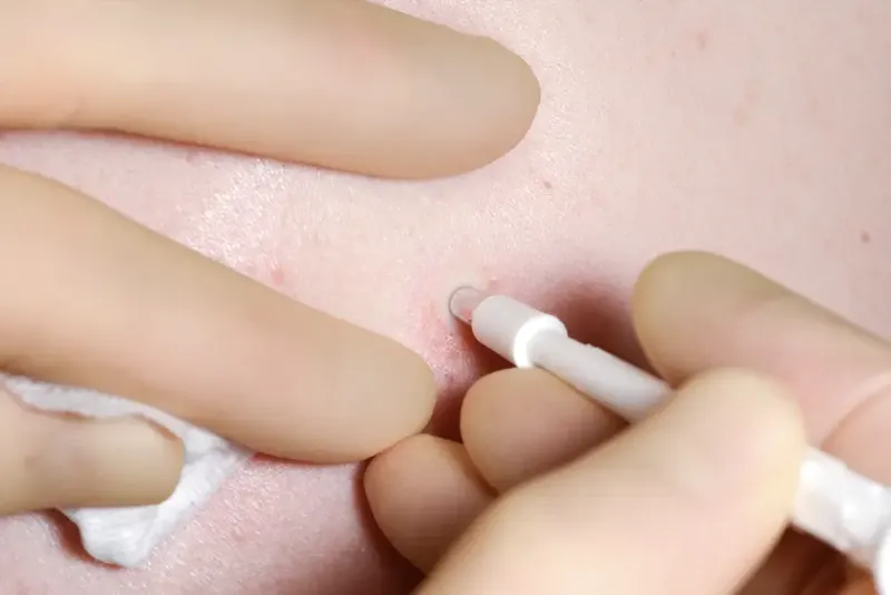 Skin Biopsy