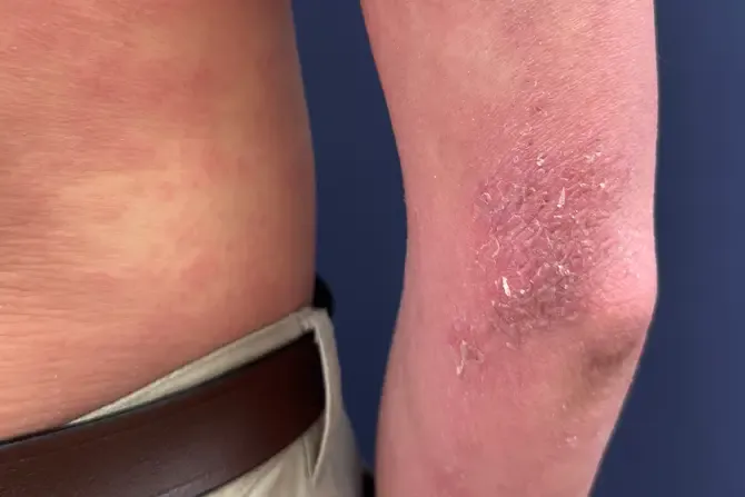 Skin Scrapes